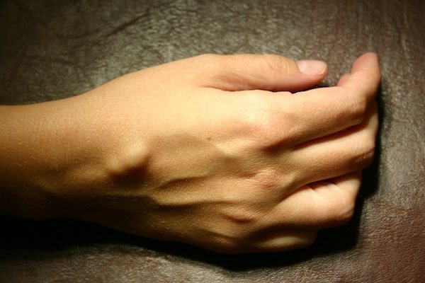 Лечение грыжи лучезапястного сустава кисти без операции Лечение грыжи лучезапястного сустава кисти без операции