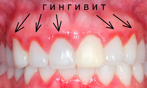 Лечение гингивита
