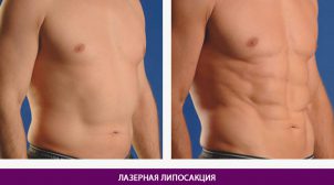(Рус) Преимущества лазерной липосакции