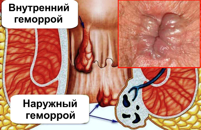 Как избавиться от геммороя Как избавиться от геммороя