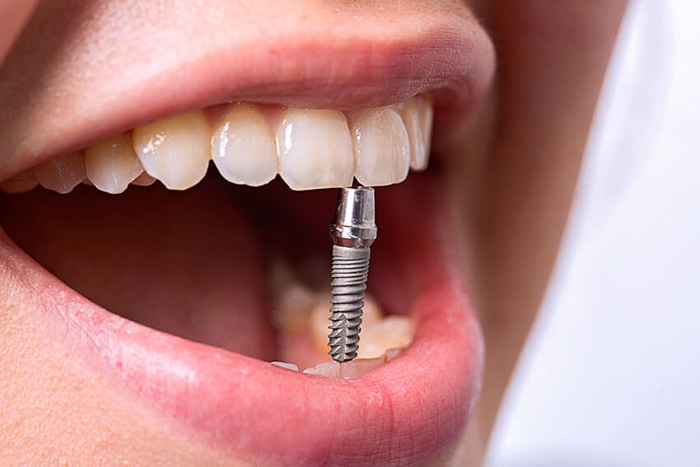 Імплантація зубів під ключ