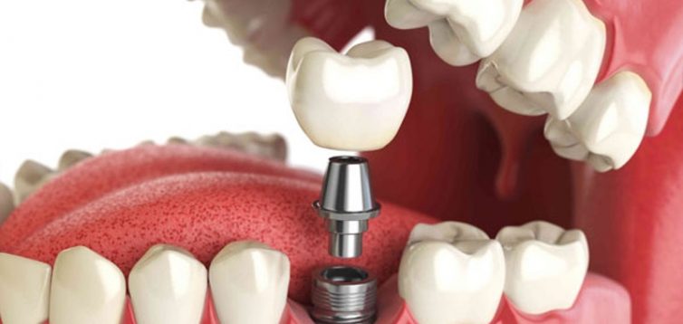 Імплантація зубів під ключ