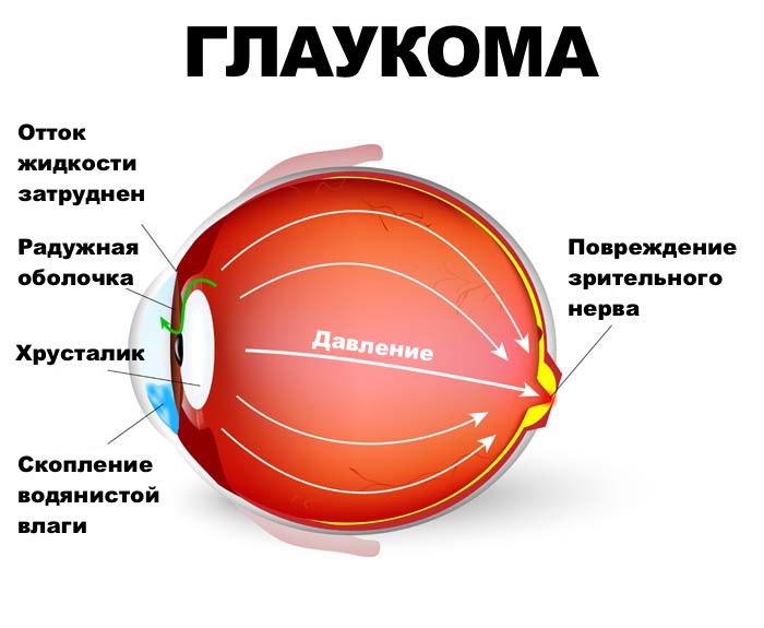 Диагностика и лечение глаукомы в Одессе Диагностика и лечение глаукомы в Одессе