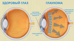 (Рус) Диагностика и лечение глаукомы в Одессе