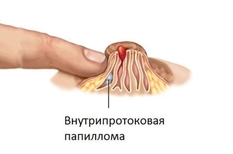 Лечение внутрипротоковой папилломы